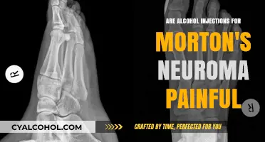 Alcohol Injections for Morton's Neuroma: Painful Procedure or Effective Relief?
