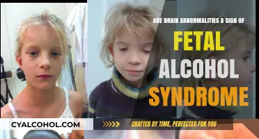 Brain Abnormalities: A Fetal Alcohol Syndrome Sign?