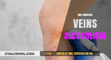 Varicose Veins and Alcoholism: Unraveling the Connection and Risks