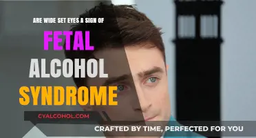 Wide-Set Eyes: A Fetal Alcohol Syndrome Sign?