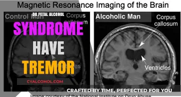 Fetal Alcohol Syndrome and Tremors: Understanding the Connection
