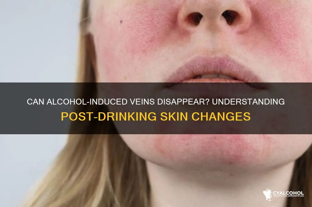 do veins go away after alcohol