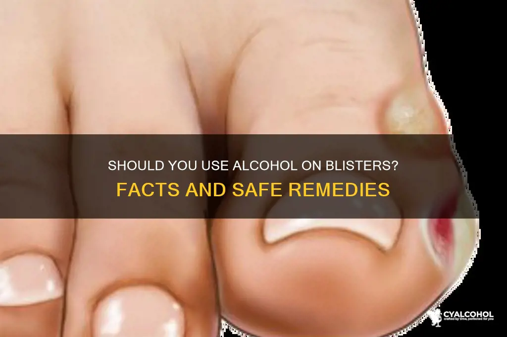 do you need to put alcohol on blisters