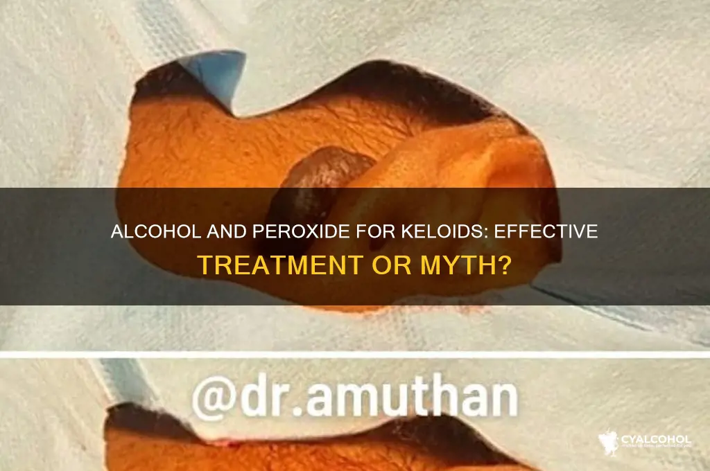 does alcohol and peroxide work for treating keloids