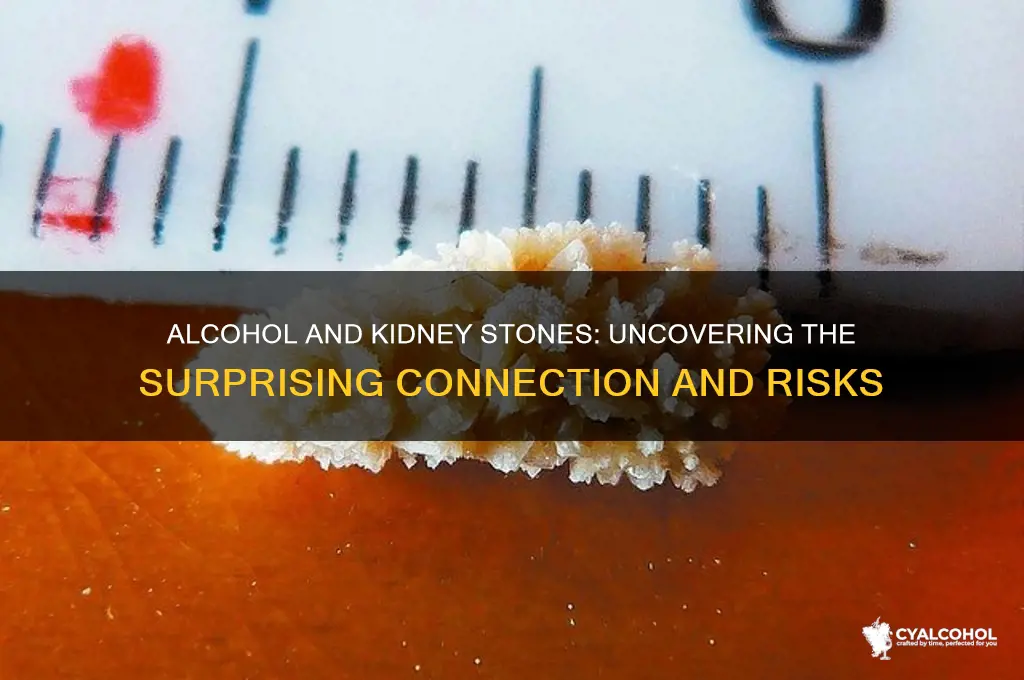 does alcohol attribute to kidney stones