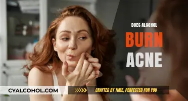 Alcohol and Acne: Does It Burn or Worsen Your Skin?