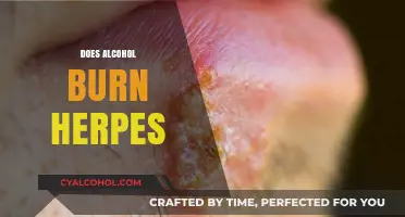 Alcohol and Herpes: Debunking Myths About Burning the Virus