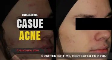 Alcohol and Acne: Uncovering the Link to Clearer Skin