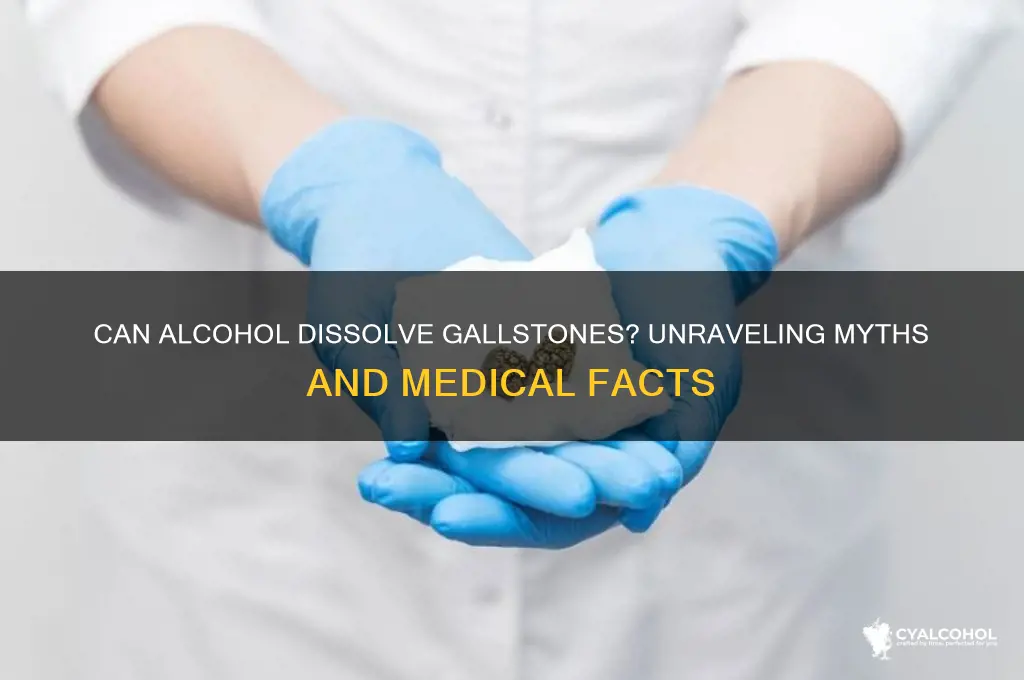 does alcohol dissolve gallstones
