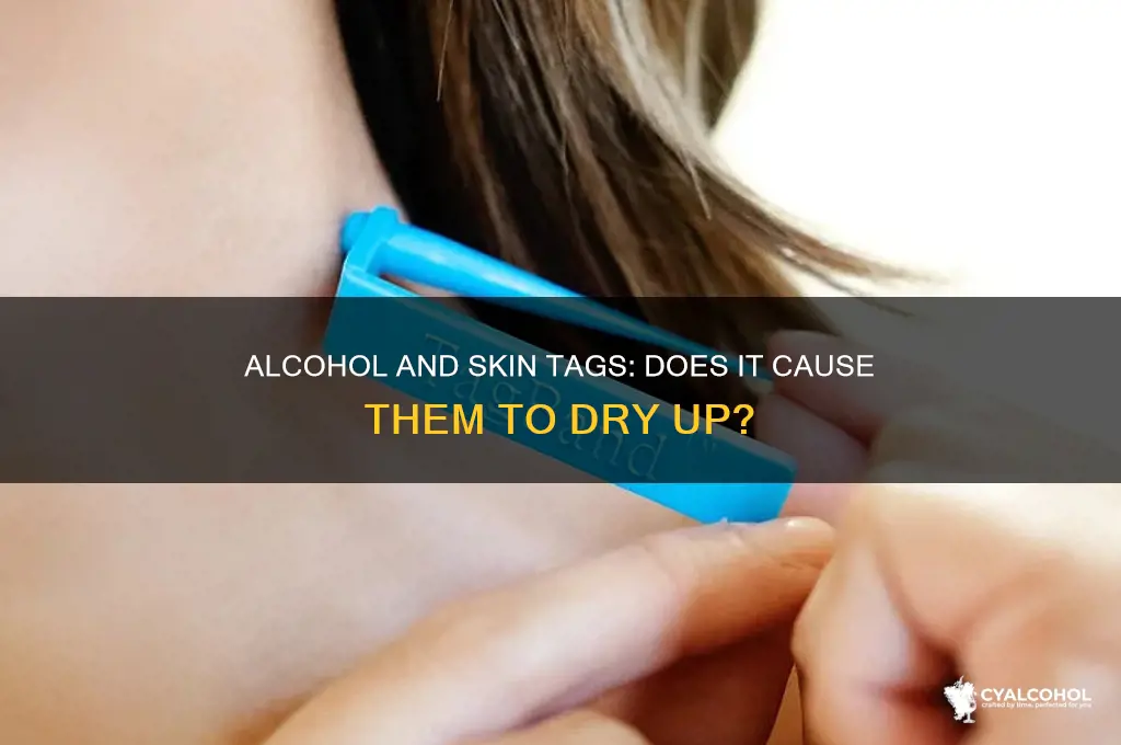 does alcohol dry up skin tags