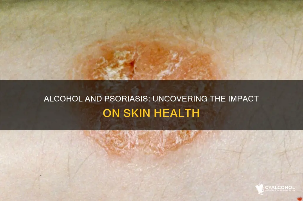 does alcohol exacerbate psoriasis