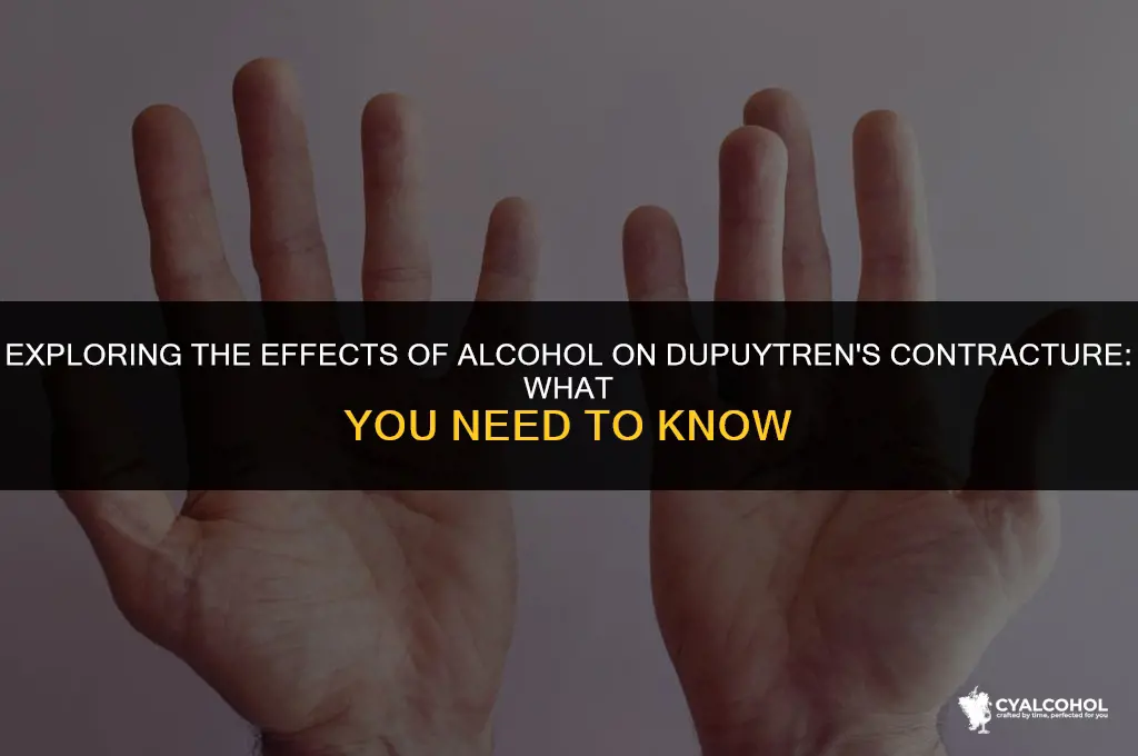 does alcohol impact dupuytren