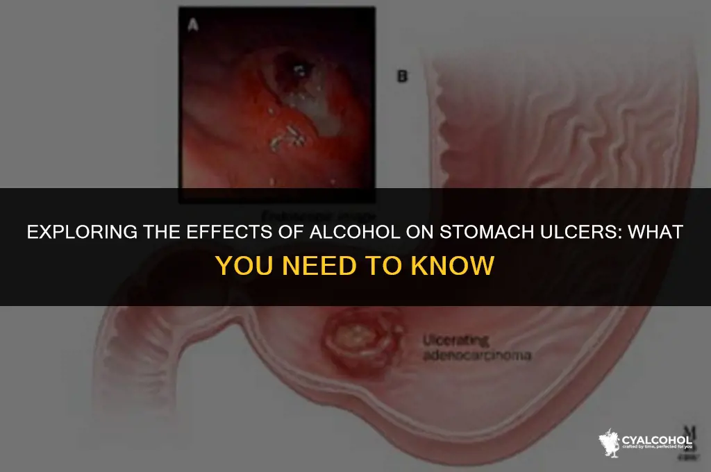 does alcohol irritate stomach ulcers