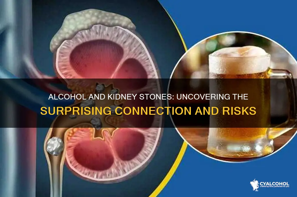 does alcohol lead to kidney stones