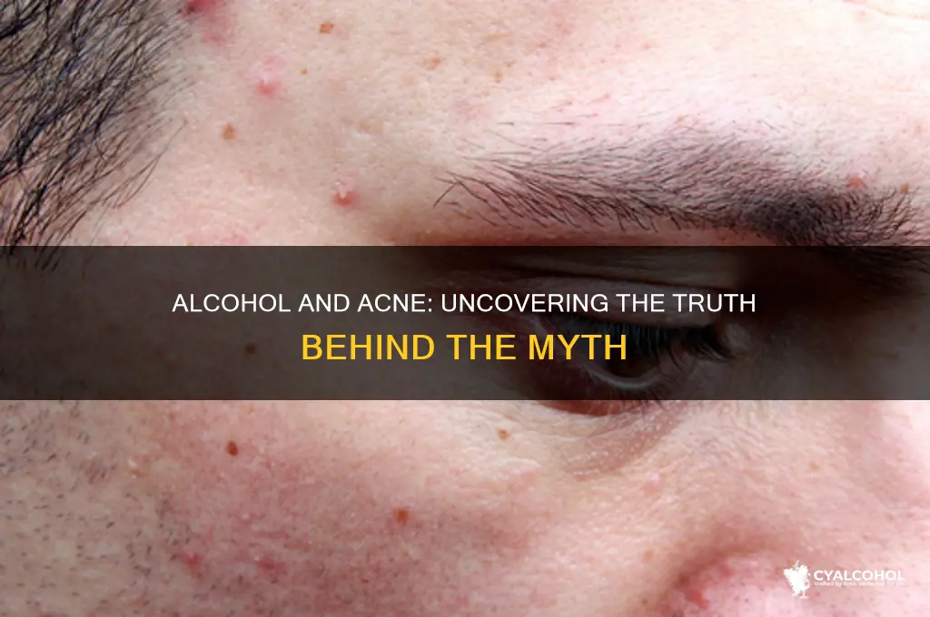 does alcohol prevent acne