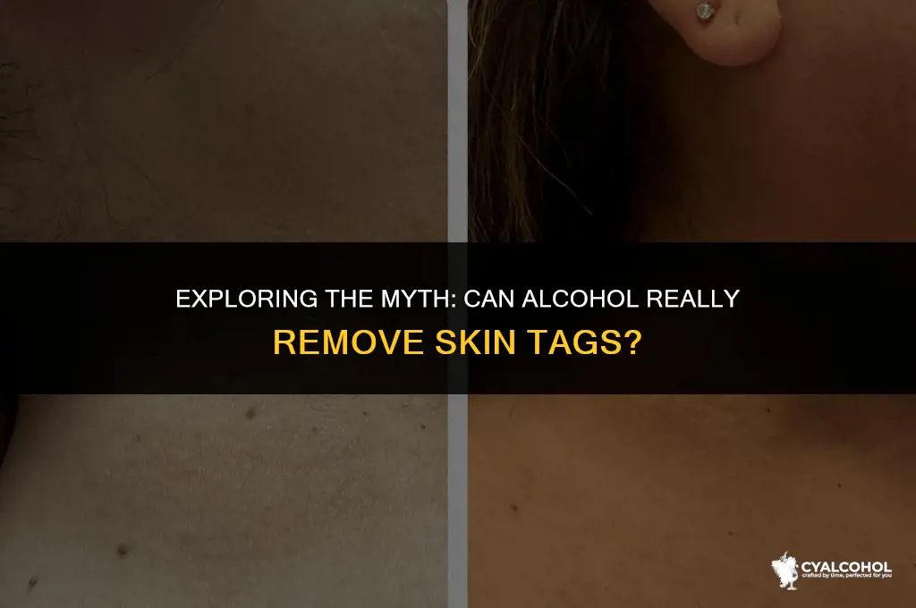 does alcohol remove skin tags