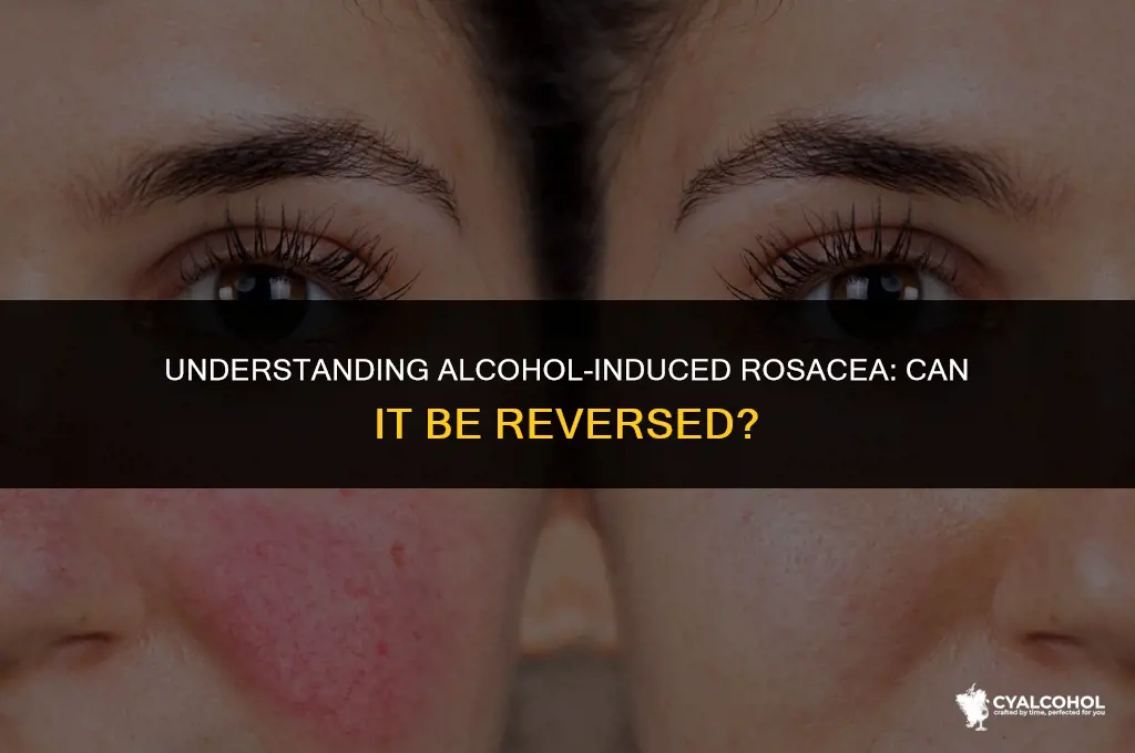 does alcohol rosacea go away