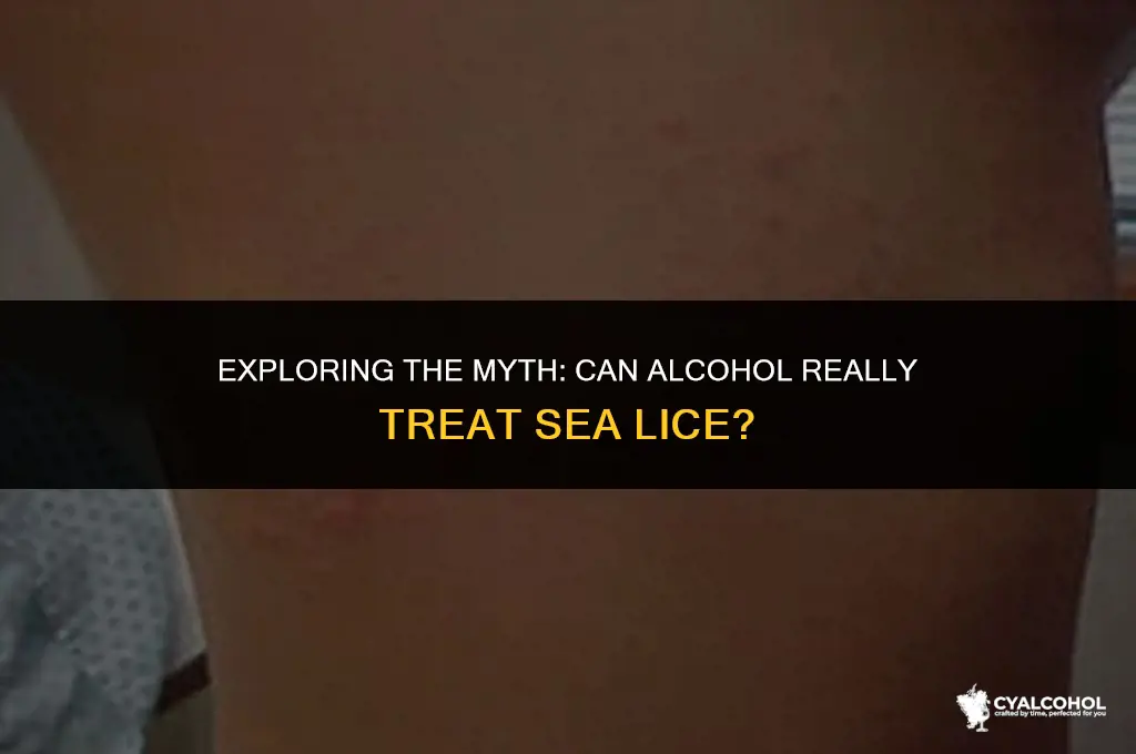 does alcohol treat sea lice