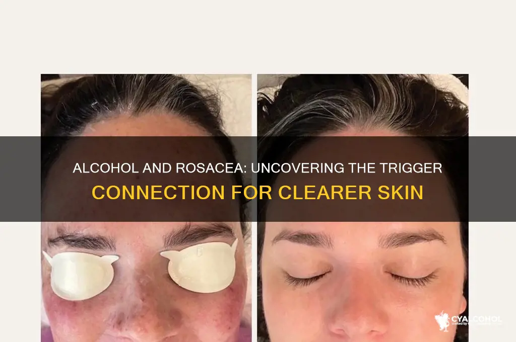 does alcohol trigger rosacea