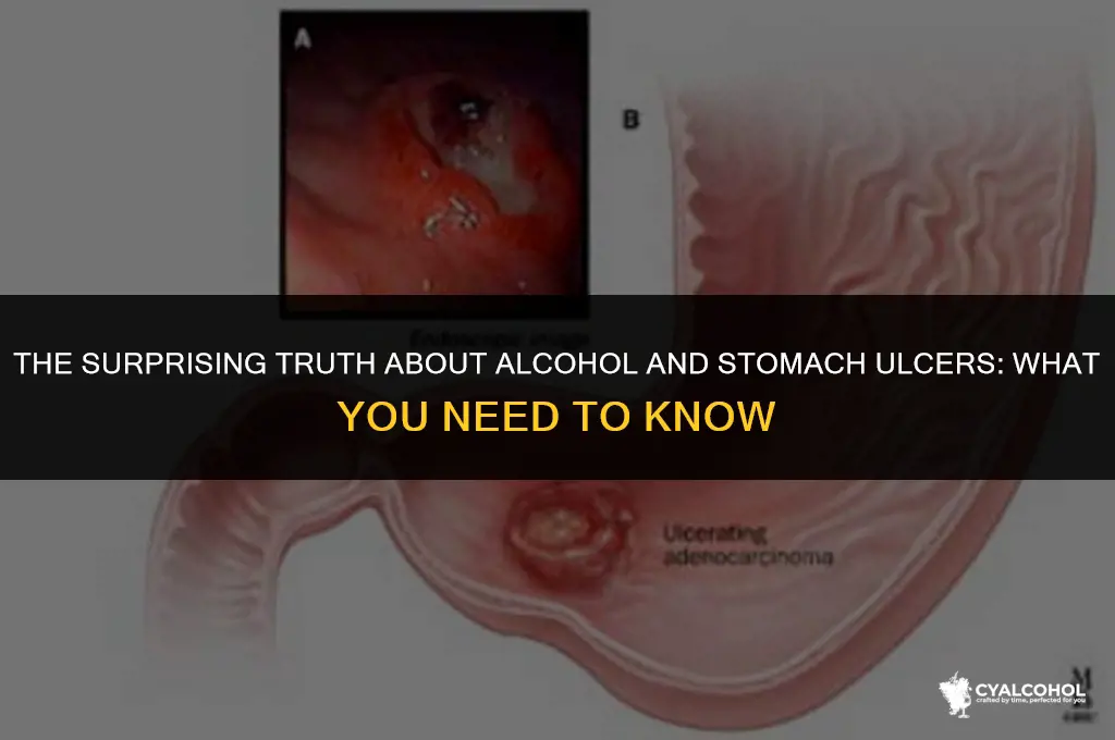 does alcohol upset stomach ulcers