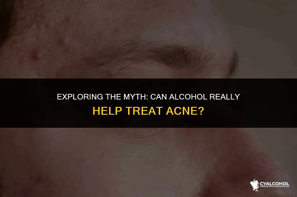 does alcohol work for acne