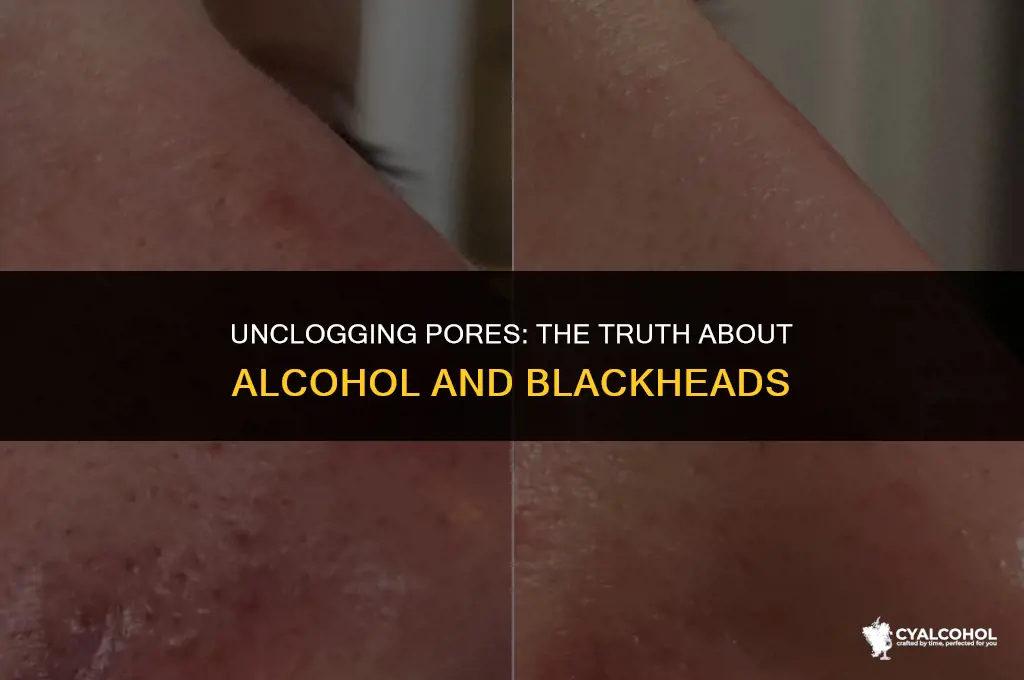 does alcohol work on blackheads