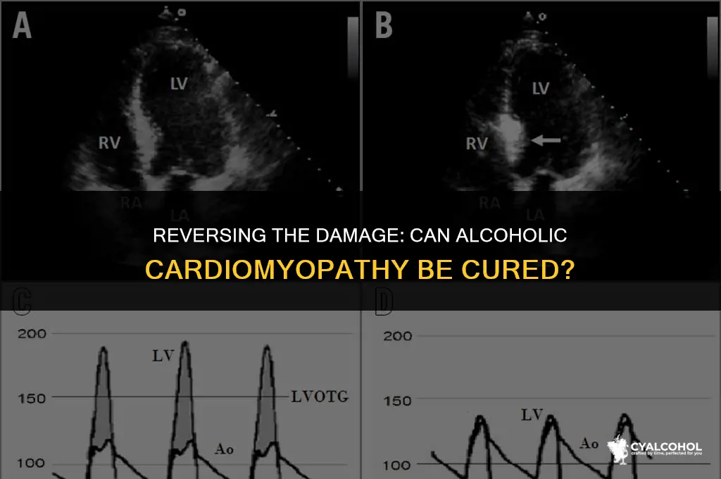 does alcoholic cardiomyopathy go away