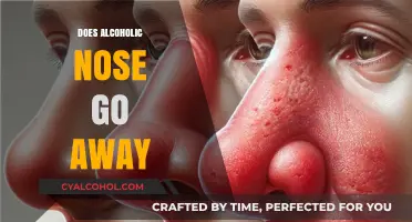 Can Alcoholic Nose Be Reversed? Understanding the Effects of Alcohol on Your Appearance
