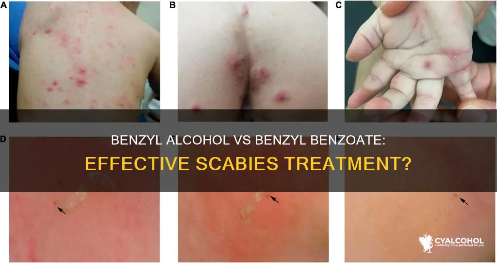 does benzyl alcohol work better thsn benzyl benzoate for scabies