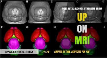 Can MRI Detect Fetal Alcohol Syndrome? Exploring Diagnostic Possibilities