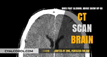 Brain Scans: Can They Detect Past Alcohol Abuse?