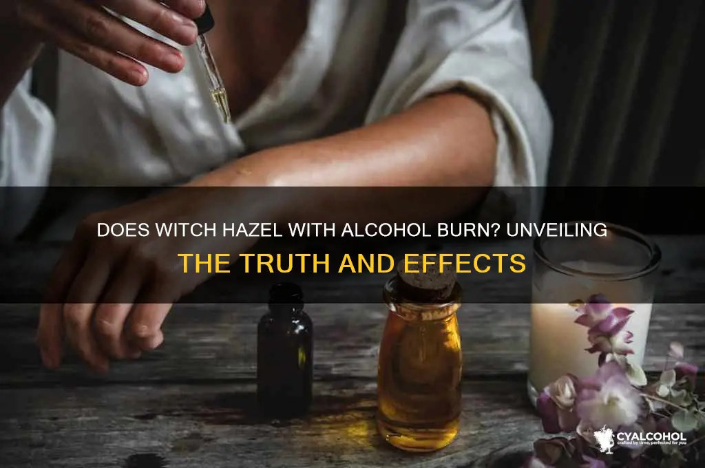 does witch hazel with alcohol burn