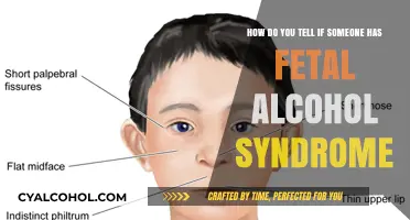 Recognizing Fetal Alcohol Syndrome: What to Look For