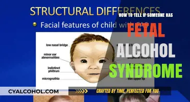 Recognizing Fetal Alcohol Syndrome: What Are the Signs?