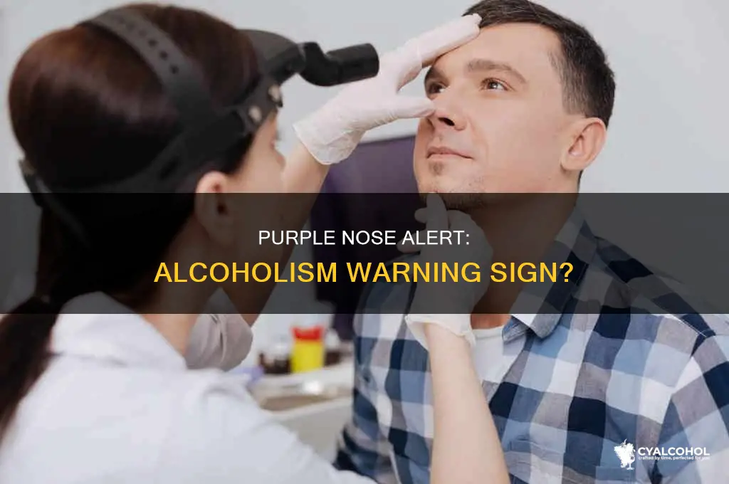 is a purple nose a sign of alcoholism