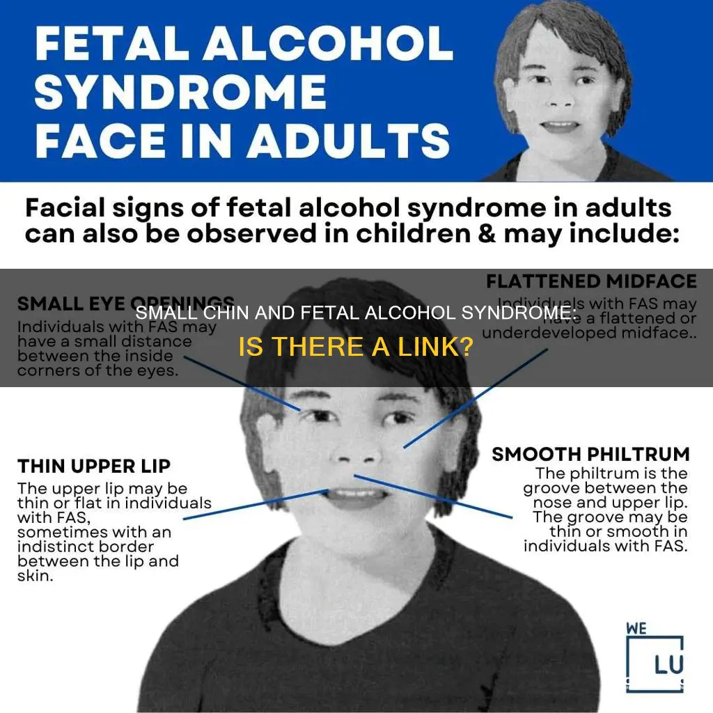 is a small chin associated with fetal alcohol syndrome