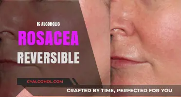 Reversing Alcoholic Rosacea: Is It Possible and How to Manage It?