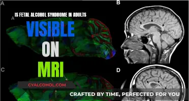 MRI Scans: Unveiling Fetal Alcohol Syndrome in Adults