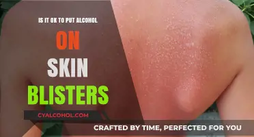 Alcohol on Skin Blisters: Safe or Not?