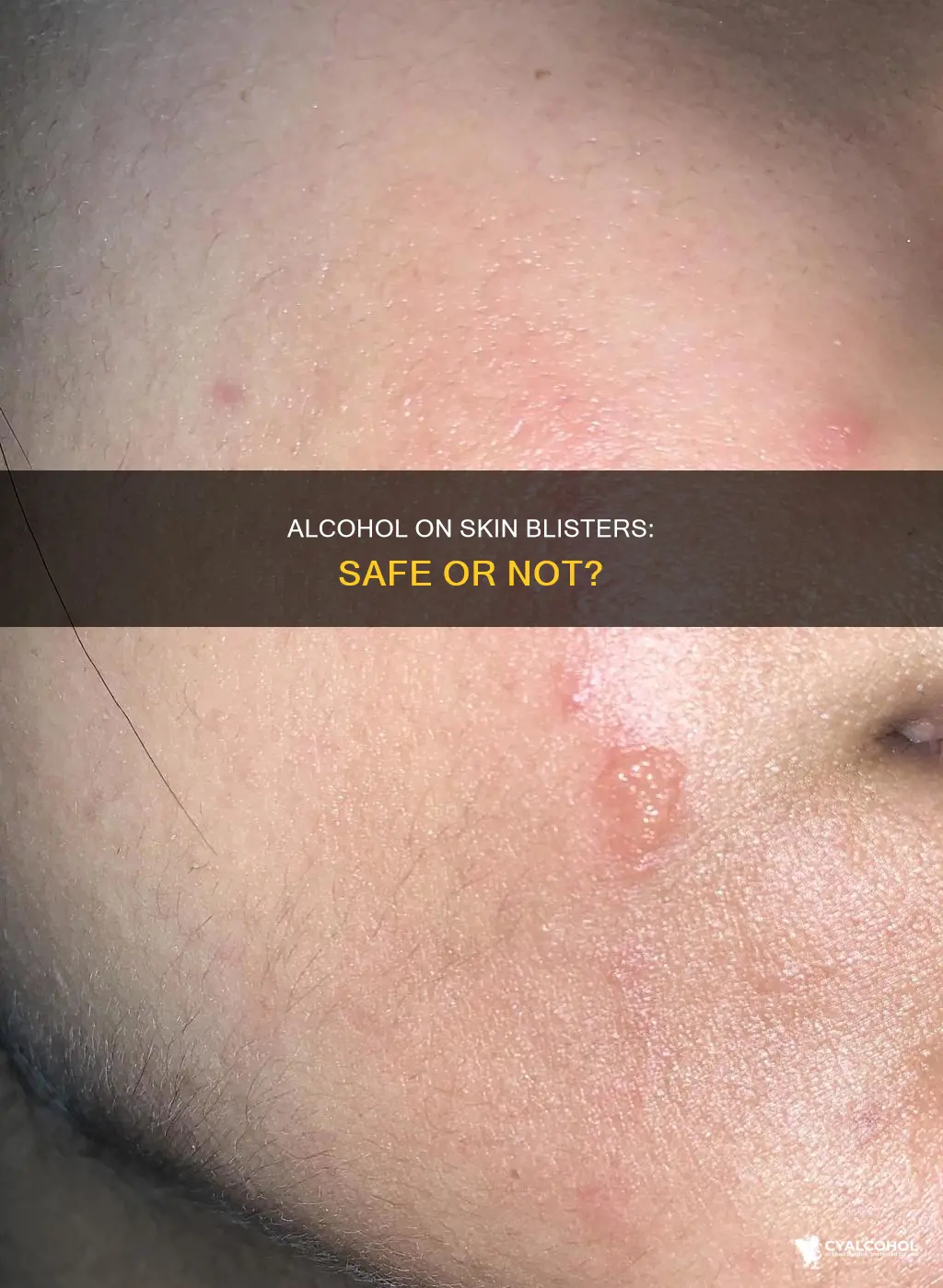 is it ok to put alcohol on skin blisters