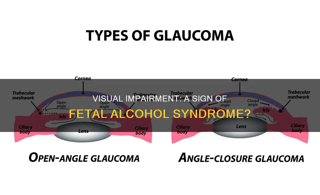 is visual impairment a sign of fetal alcohol syndrome