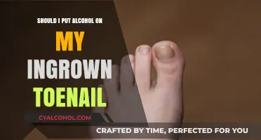 Alcohol for Ingrown Toenails: Effective Remedy or Risky Practice?