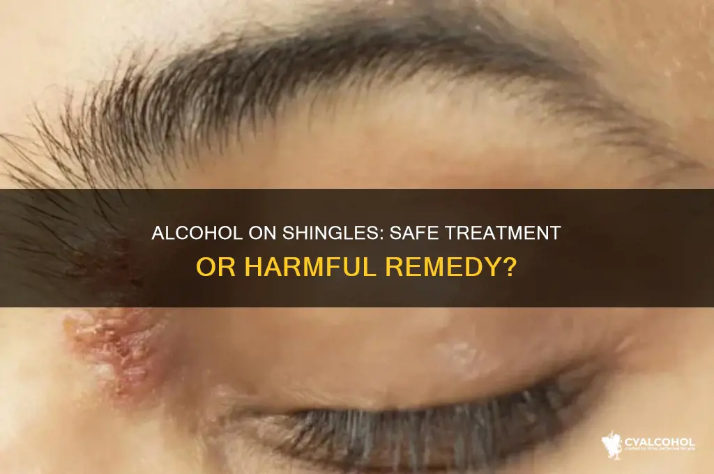 should you put alcohol on shingles