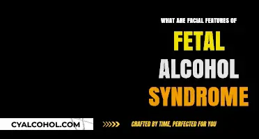 Understanding Fetal Alcohol Syndrome: Key Facial Features Explained