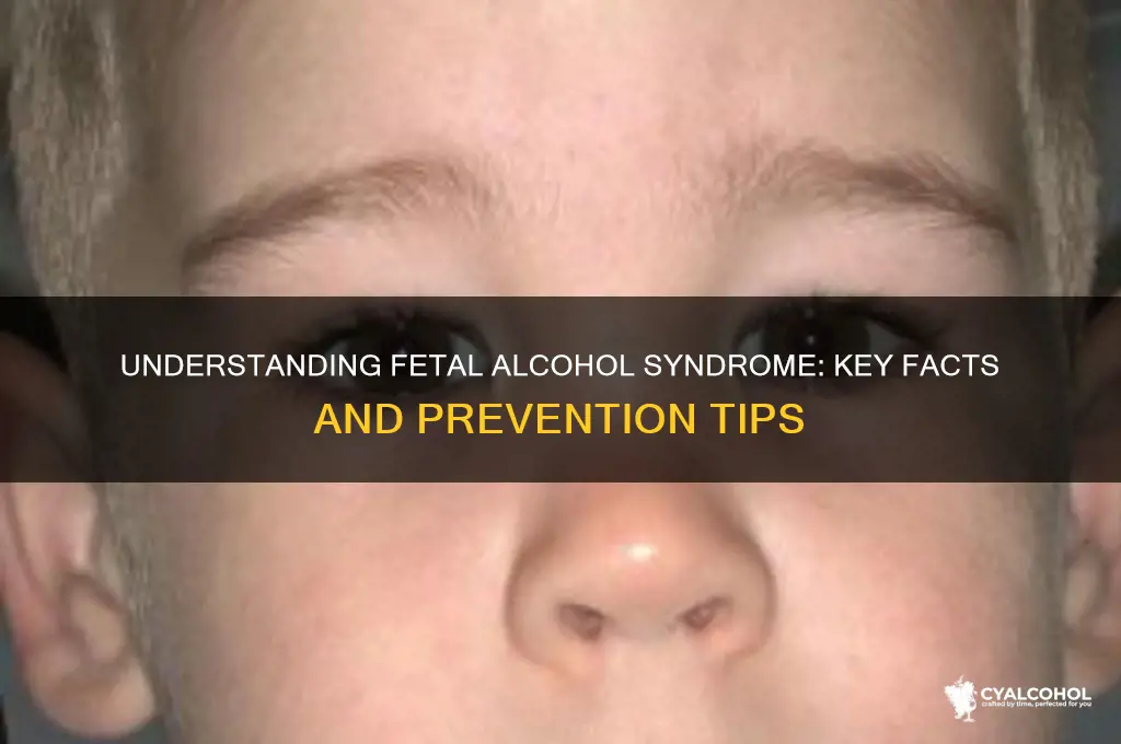 what are some facts about fetal alcohol syndrome