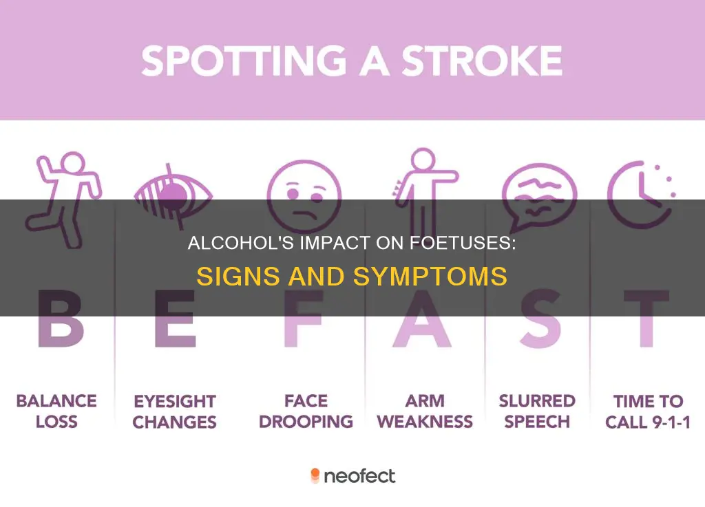 what are the signs and symptoms of foetal alcohol syndrome