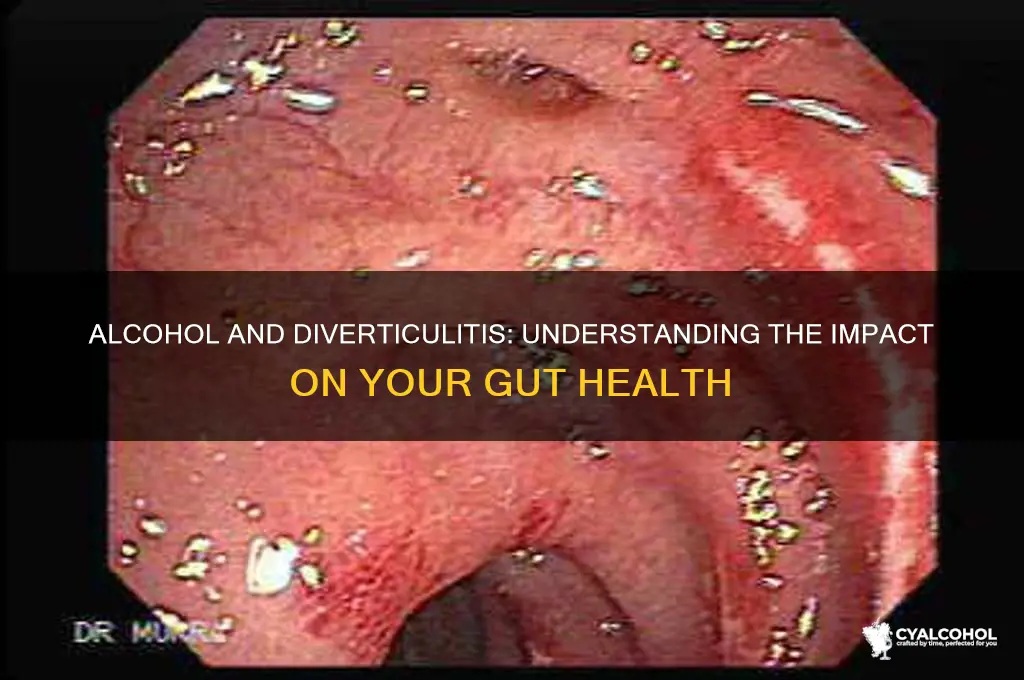 what does alcohol do to diverticulitis