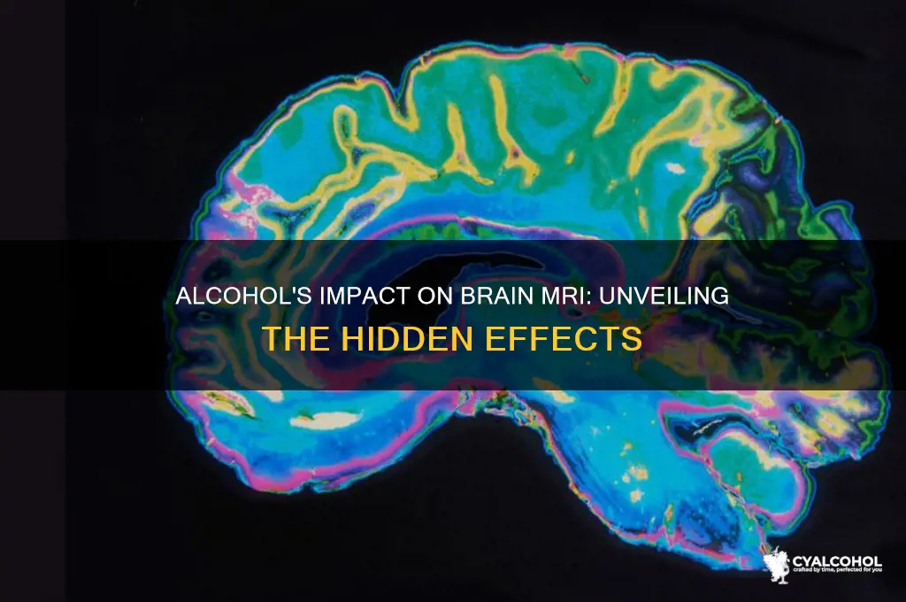 what does alcohol do to your brain mri