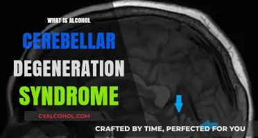 Understanding Alcohol Cerebellar Degeneration Syndrome: Causes and Effects