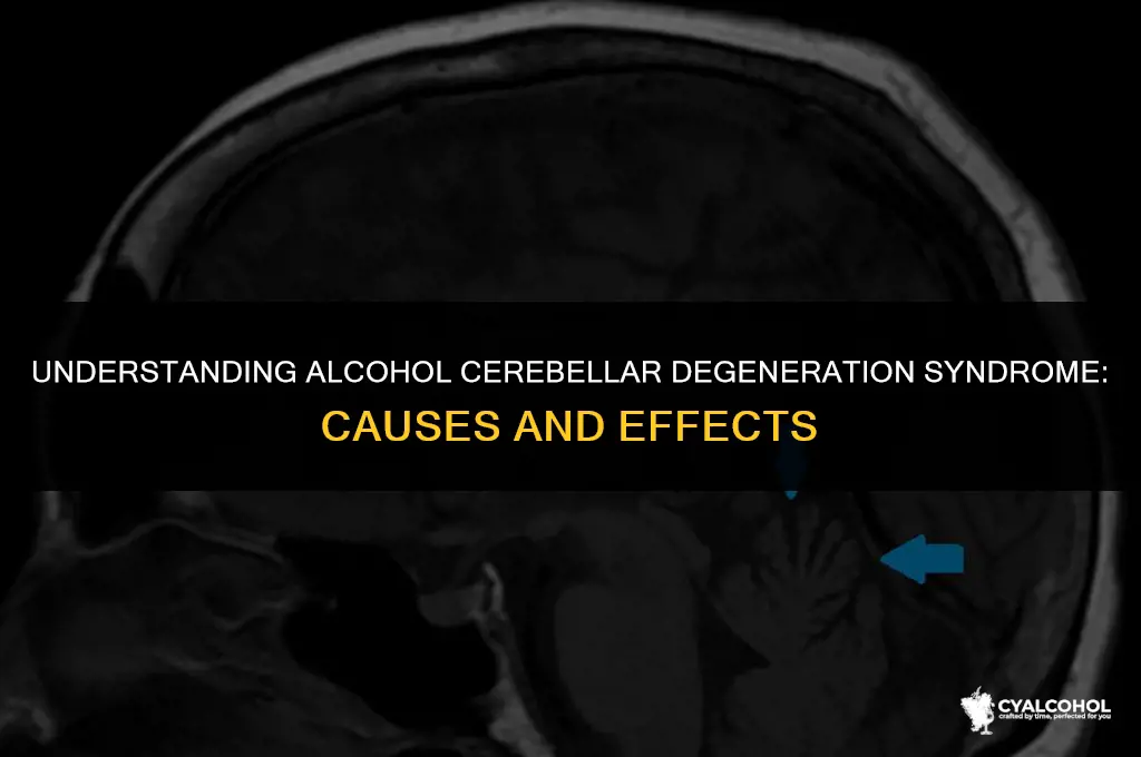 what is alcohol cerebellar degeneration syndrome